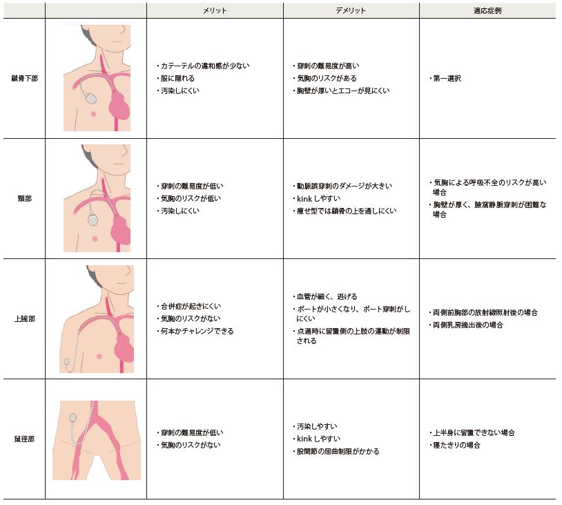 Novellus Vol.45 ポート留置位置の選択