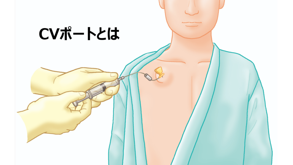 CVポートとは?