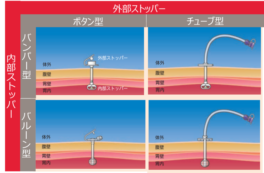 胃ろうカテーテルの種類