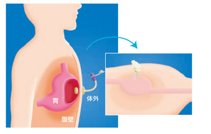 胃ろうイラスト