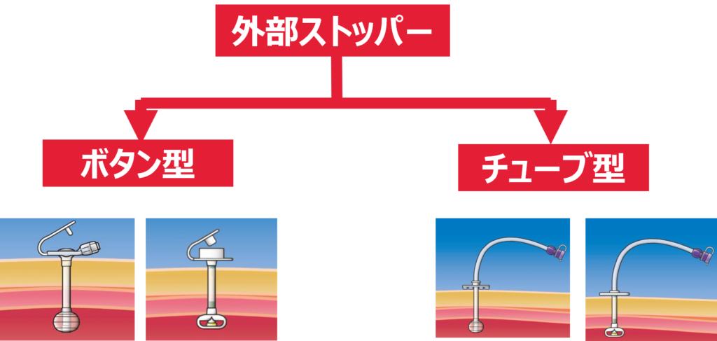 胃ろう_外部ストッパーによる分類