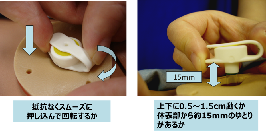 胃ろう_外部ストッパーの日常管理